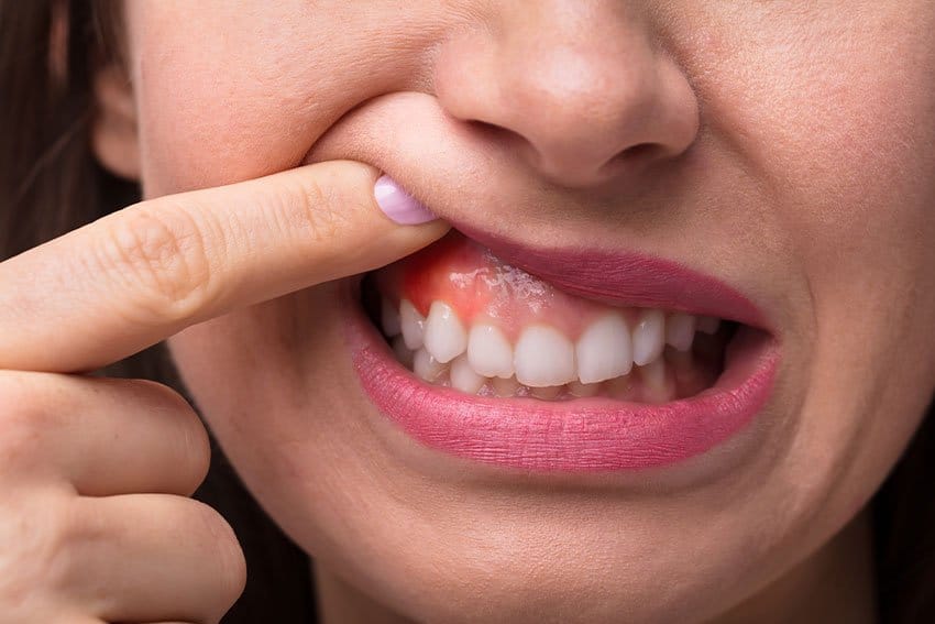 woman lifting her lip, showing red, swollen gum tissue