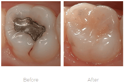 comparison of a metal filling and a tooth colored filling