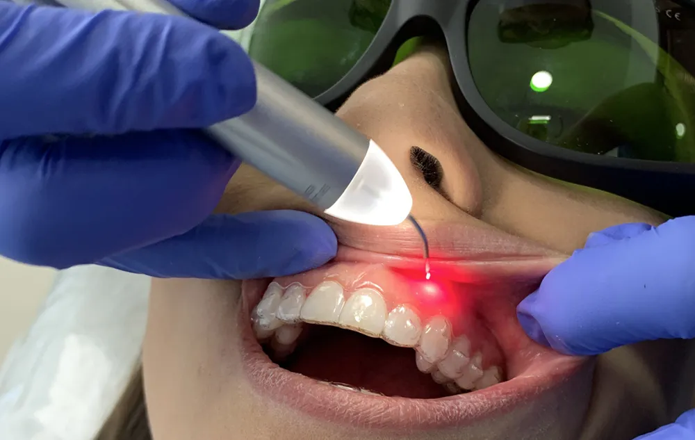 Patient Receiving Laser Dentistry Treatment At élan Tulsa Cosmetic Dentistry In Tulsa, Oklahoma