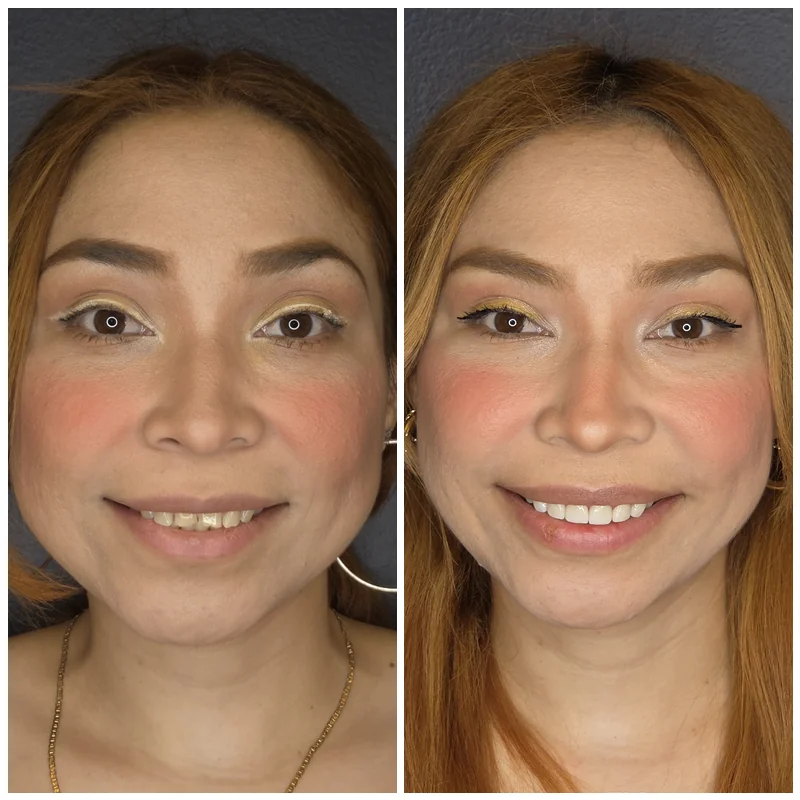Cosmetic Dentistry Patient Before and After 3