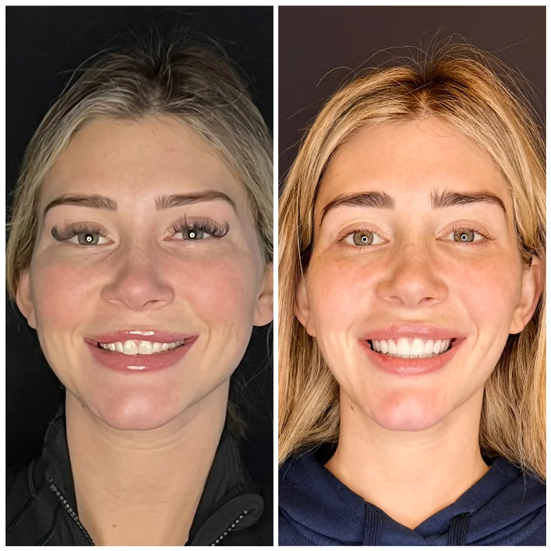 Cosmetic Dentistry Patient Before And After