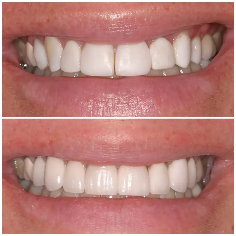 Patient #1 Cosmetic Smile Makeover Before And After At élan Tulsa Cosmetic Dentistry In Tulsa, Oklahoma