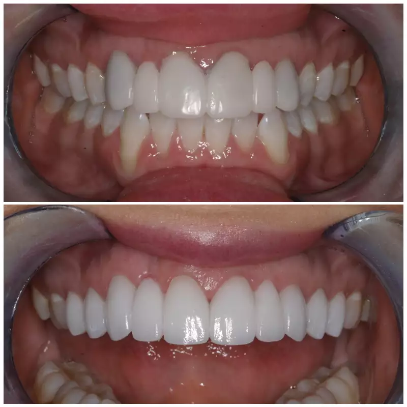 Patient #2 Cosmetic Smile Makeover Before And After At élan Tulsa Cosmetic Dentistry