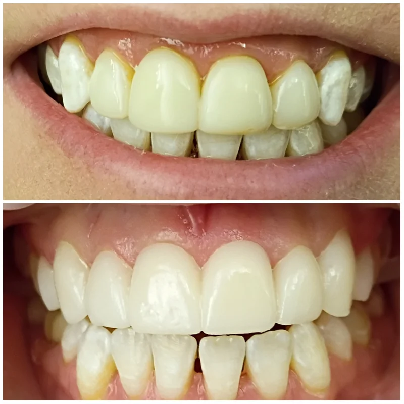 Cosmetic Smile Makeover Before After 2026 3