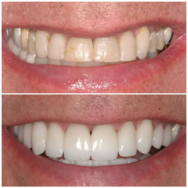 Patient #4 Cosmetic Smile Makeover Before And After At élan Tulsa Cosmetic Dentistry