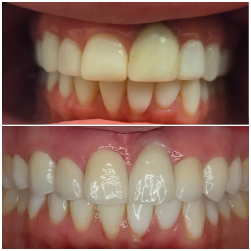 Cosmetic Smile Makeover Before After 5