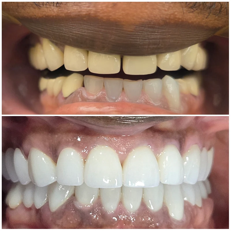 Cosmetic Smile Makeover Before and After 6
