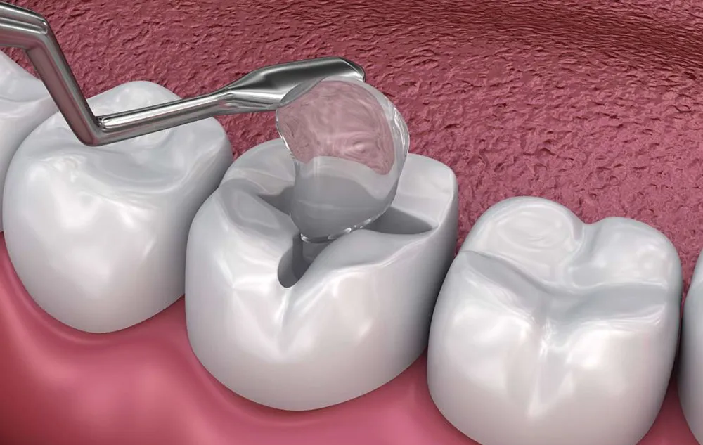 Dental Fillings For A Tooth At élan Tulsa Cosmetic Dentistry In Tulsa, Oklahoma