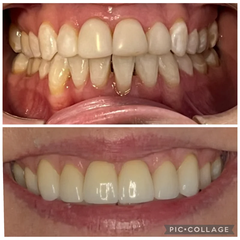 Elan Porcelain Veneers Before And After Teeth