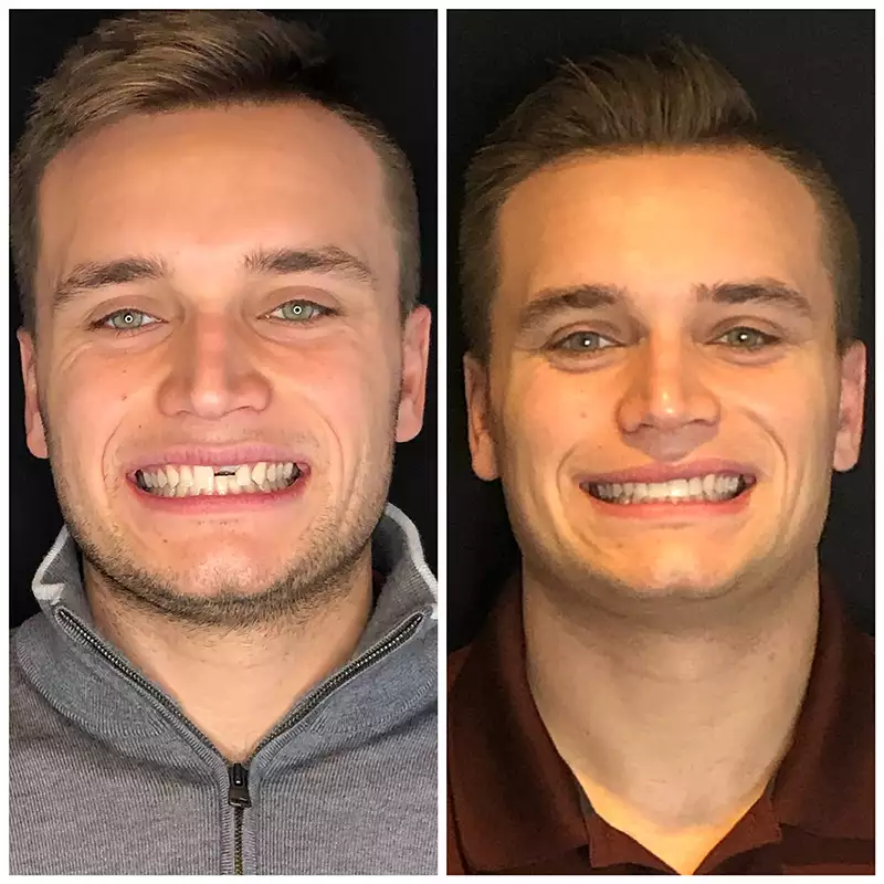 Patient #1 Before And After Smile Transformation At élan Tulsa Cosmetic Dentistry In Tulsa, Oklahoma