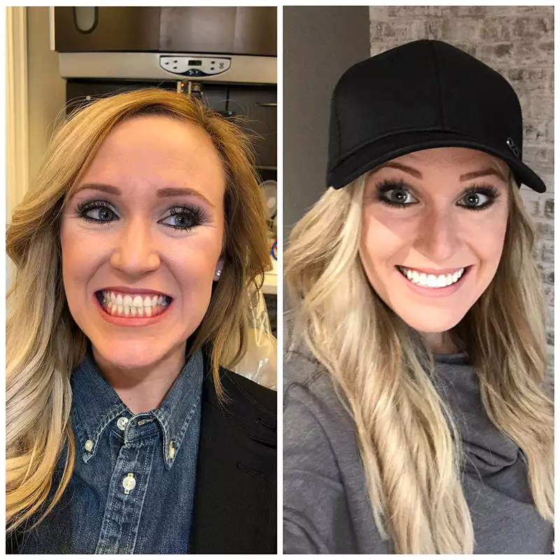 Patient #10 Before And After Smile Transformation At élan Tulsa Cosmetic Dentistry In Tulsa, Oklahoma