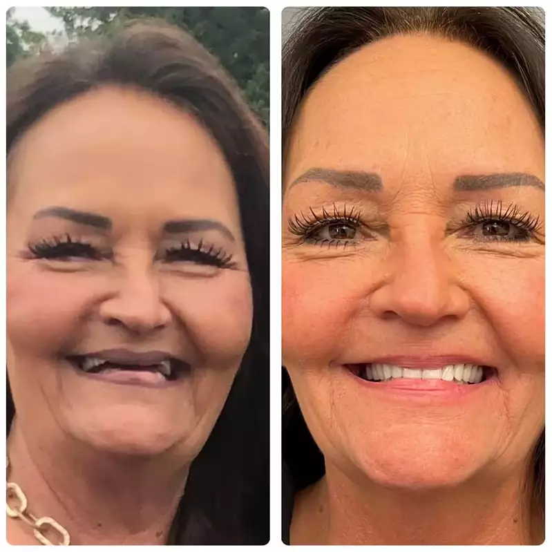 Patient #11 Before And After Smile Transformation At élan Tulsa Cosmetic Dentistry In Tulsa, Oklahoma