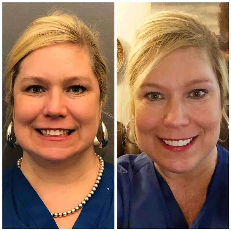 Patient #12 Before And After Smile Transformation At élan Tulsa Cosmetic Dentistry In Tulsa, Oklahoma
