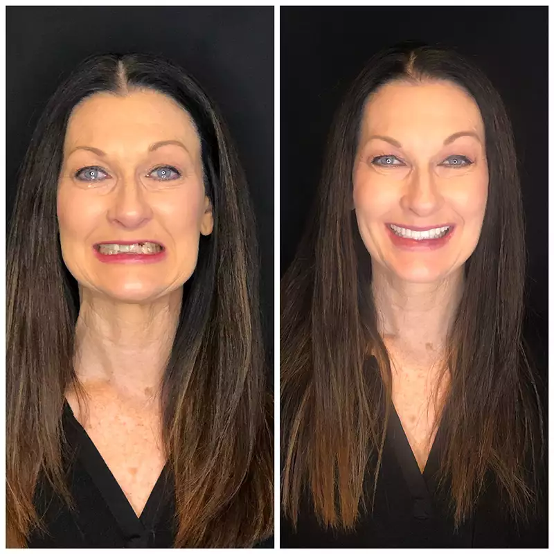 Patient #2 Before And After Smile Transformation At élan Tulsa Cosmetic Dentistry In Tulsa, Oklahoma
