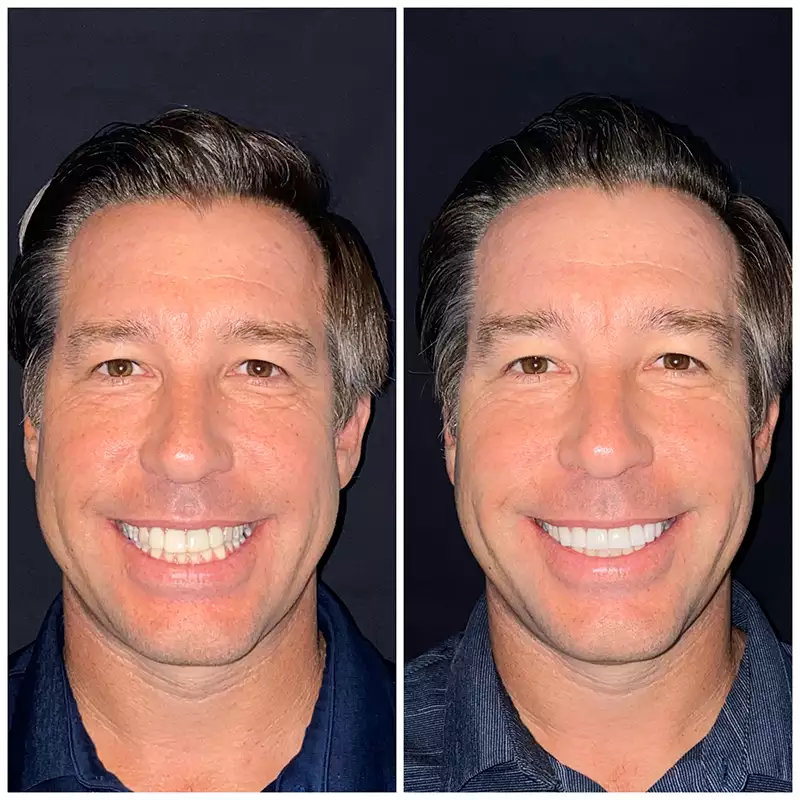 Patient #3 Before And After Smile Transformation At élan Tulsa Cosmetic Dentistry In Tulsa, Oklahoma