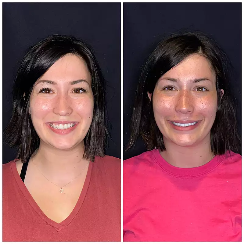 Patient #4 Before And After Smile Transformation At élan Tulsa Cosmetic Dentistry In Tulsa, Oklahoma