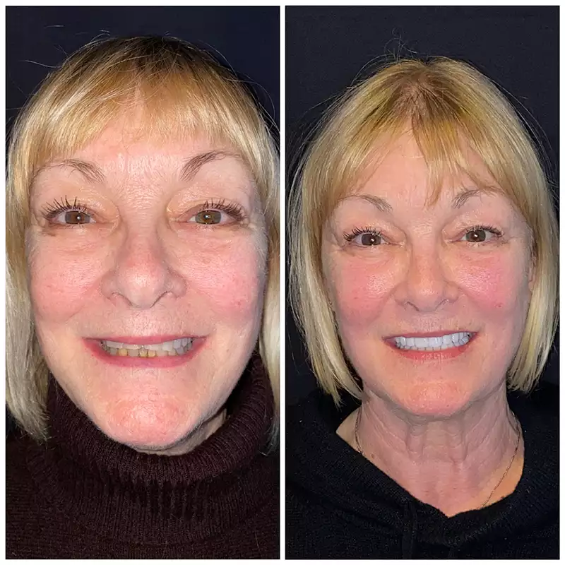 Patient #5 Before And After Smile Transformation At élan Tulsa Cosmetic Dentistry In Tulsa, Oklahoma