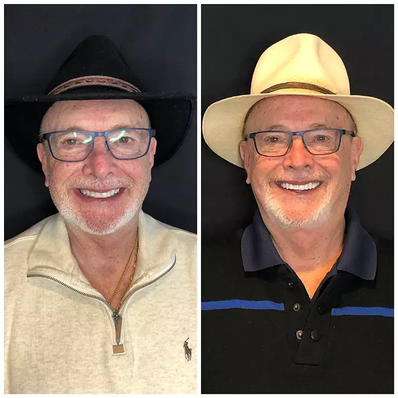 Patient #6 Before And After Smile Transformation At élan Tulsa Cosmetic Dentistry In Tulsa, Oklahoma