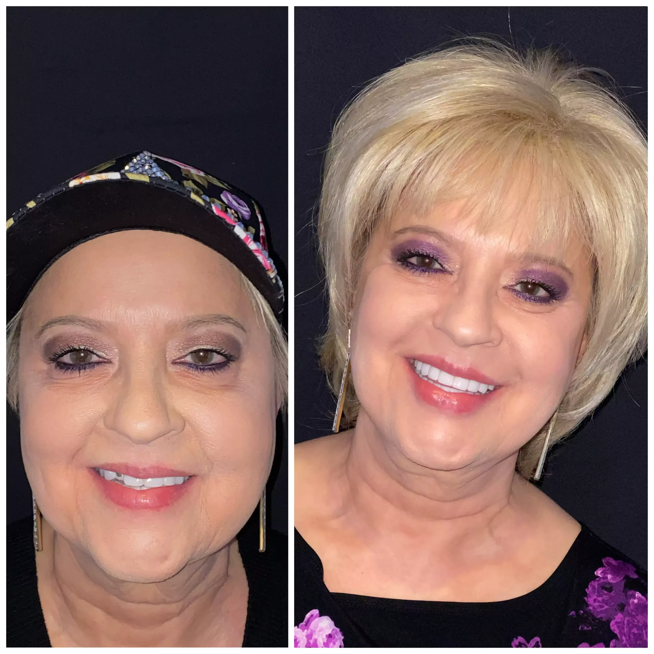 Patient #7 Before And After Smile Transformation At élan Tulsa Cosmetic Dentistry In Tulsa, Oklahoma