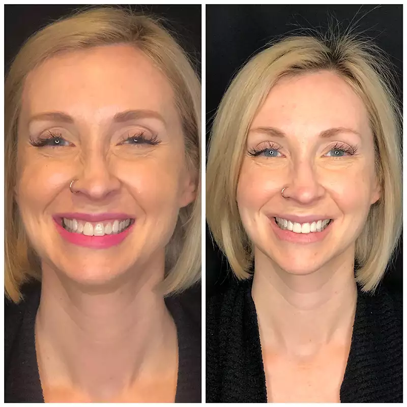 Patient #8 Before And After Smile Transformation At élan Tulsa Cosmetic Dentistry In Tulsa, Oklahoma