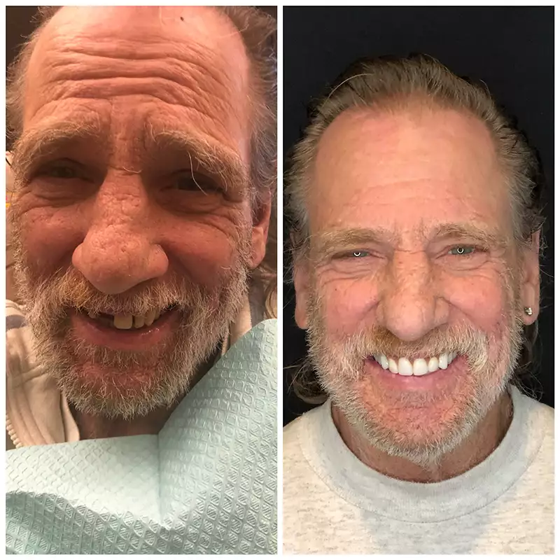 Patient #9 Before And After Smile Transformation At élan Tulsa Cosmetic Dentistry In Tulsa, Oklahoma