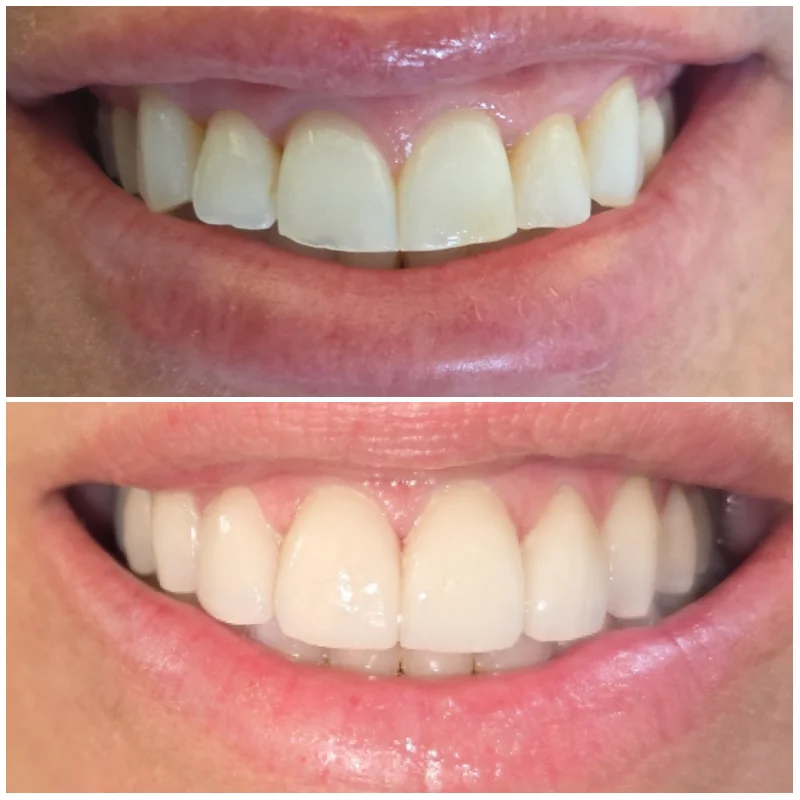 Porcelain Veneers Tulsa Cosmetic Patient 2026