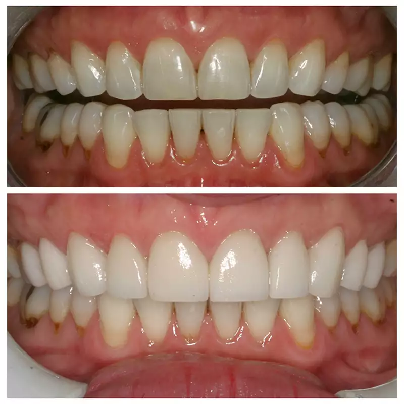 Patient #14 Cosmetic Smile Makeover Before And After At élan Tulsa Cosmetic Dentistry