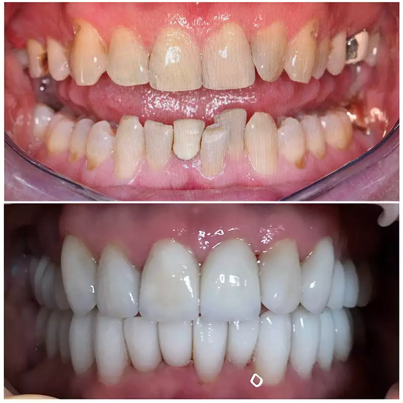 Patient #15 Cosmetic Smile Makeover Before And After At élan Tulsa Cosmetic Dentistry