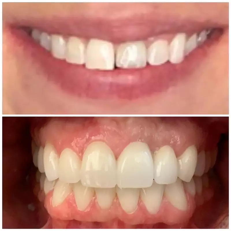Patient #16 Cosmetic Smile Makeover Before And After At élan Tulsa Cosmetic Dentistry