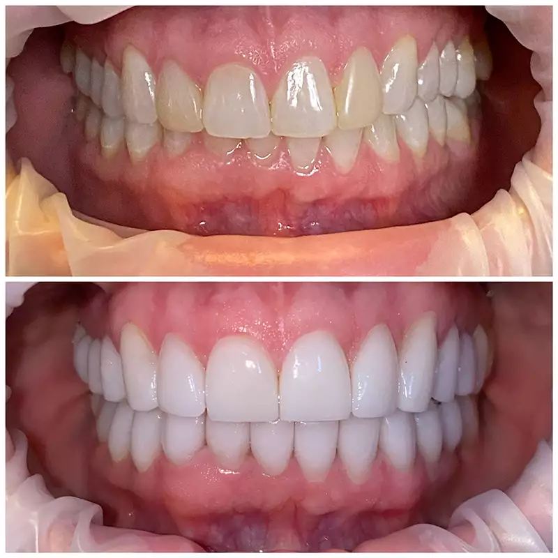 Patient #6 Cosmetic Smile Makeover Before And After At élan Tulsa Cosmetic Dentistry