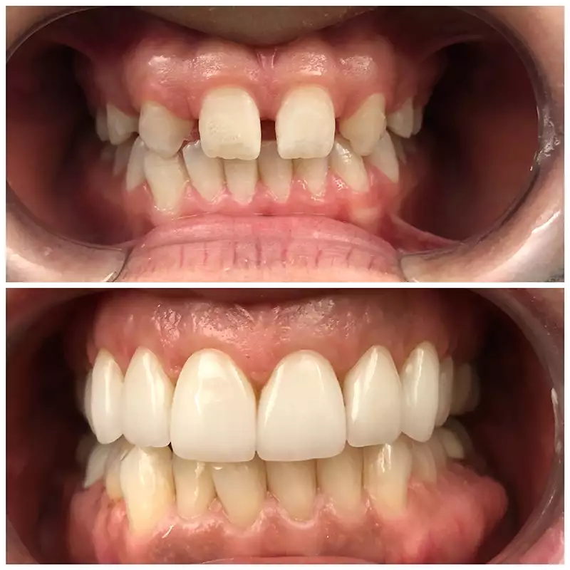 Patient #7 Cosmetic Smile Makeover Before And After At élan Tulsa Cosmetic Dentistry