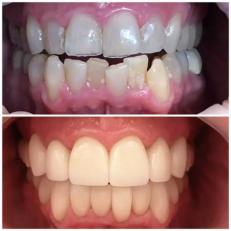 Patient #8 Cosmetic Smile Makeover Before And After At élan Tulsa Cosmetic Dentistry