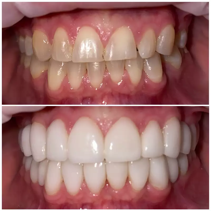 Patient #9 Cosmetic Smile Makeover Before And After At élan Tulsa Cosmetic Dentistry