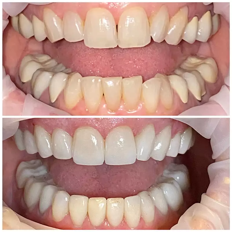 Patient #10 Cosmetic Smile Makeover Before And After At élan Tulsa Cosmetic Dentistry