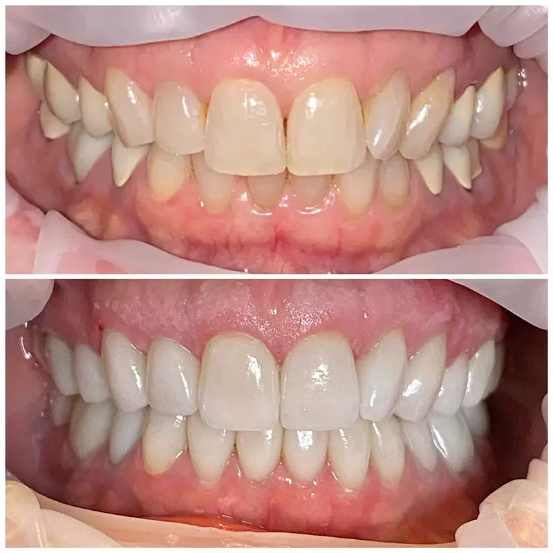 Patient #11 Cosmetic Smile Makeover Before And After At élan Tulsa Cosmetic Dentistry