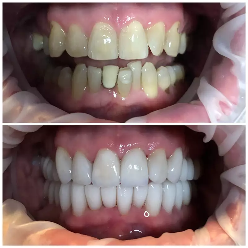 Patient #13 Cosmetic Smile Makeover Before And After At élan Tulsa Cosmetic Dentistry