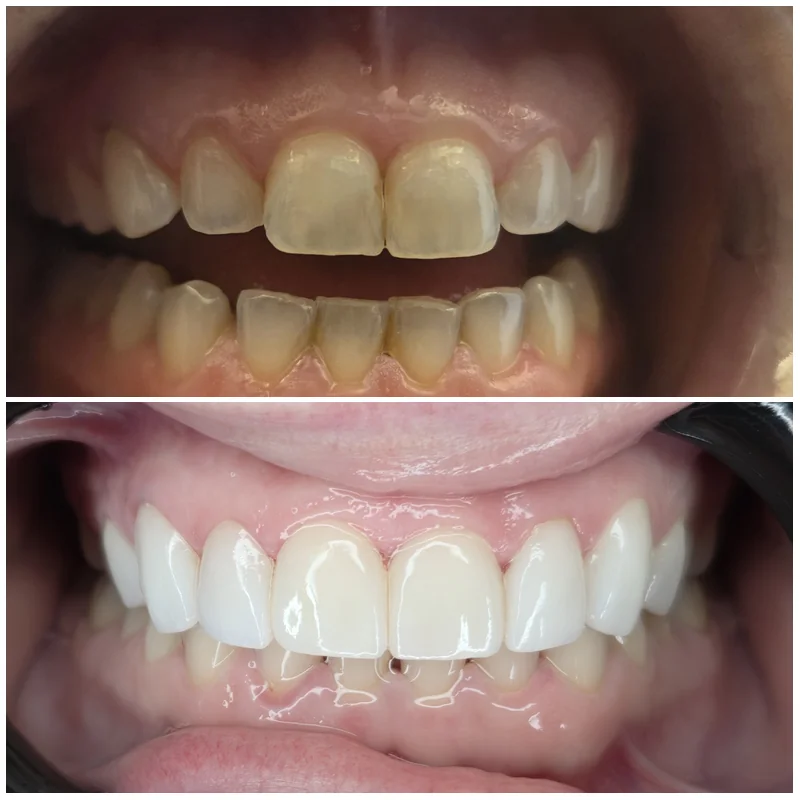 Veneers Before And After 2026 2