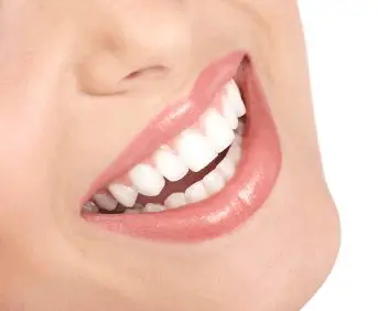 A white smile Cosmetic Gum Lift Procedure