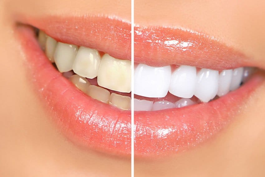 comparison of teeth whitening