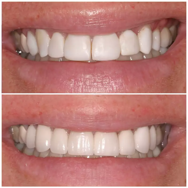 Cosmetic Smile Makeover Before & After