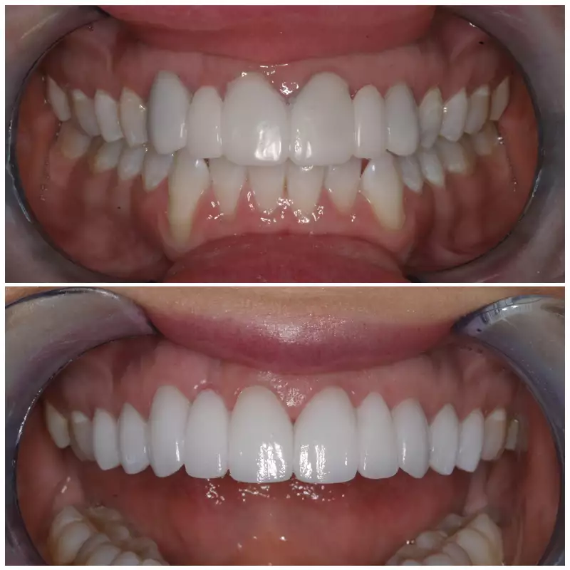 Cosmetic Smile Makeover Before & After Patient 2