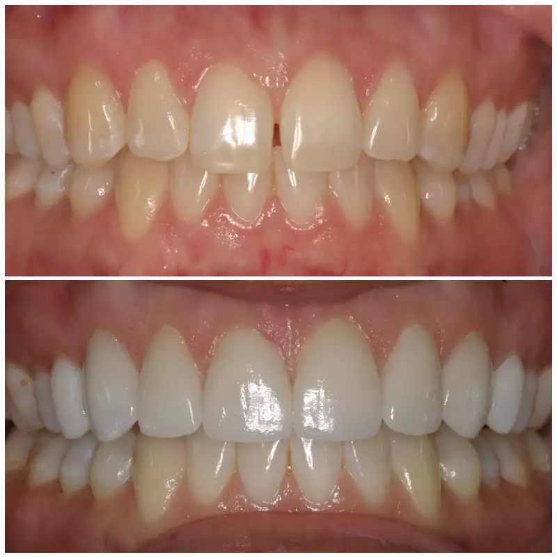 Cosmetic Smile Makeover Before & After Patient 3