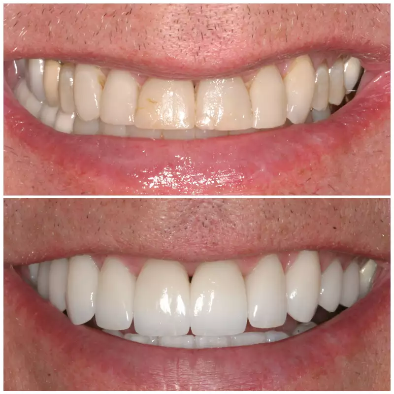 Cosmetic Smile Makeover Before & After Patient 4