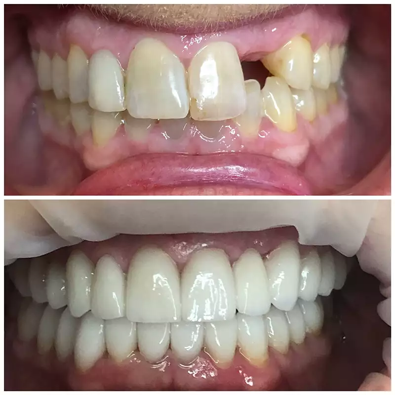Dental Implants Before & After 1