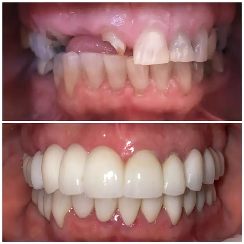 Dental Implants Before & After 2