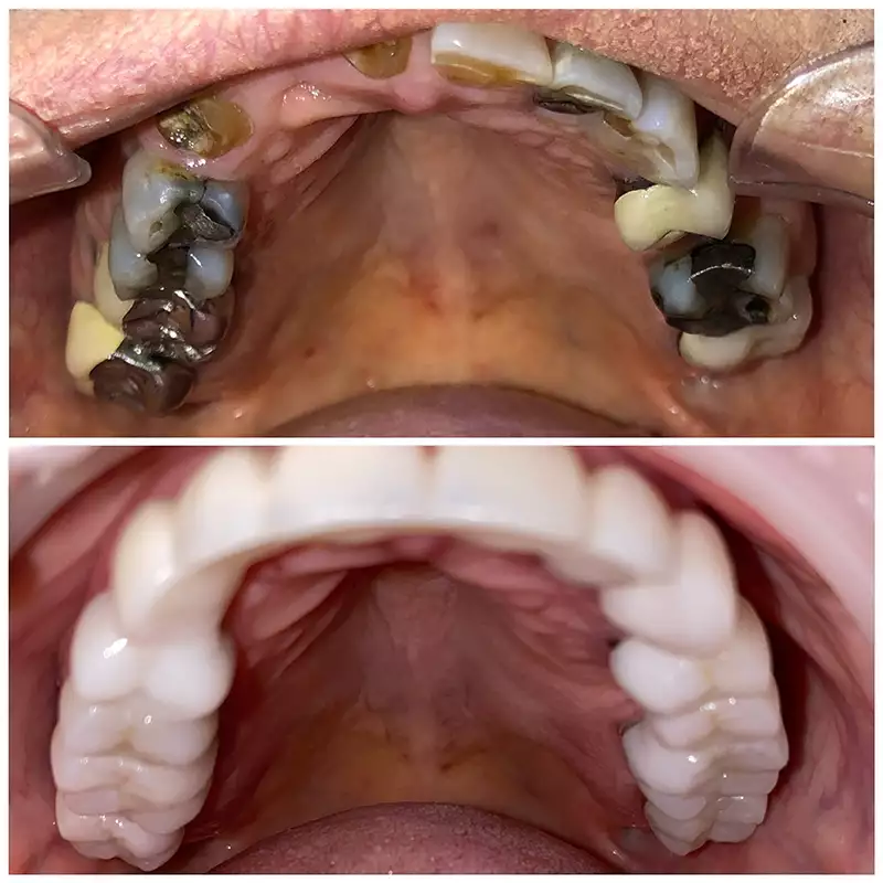 Dental Implants Before & After 3
