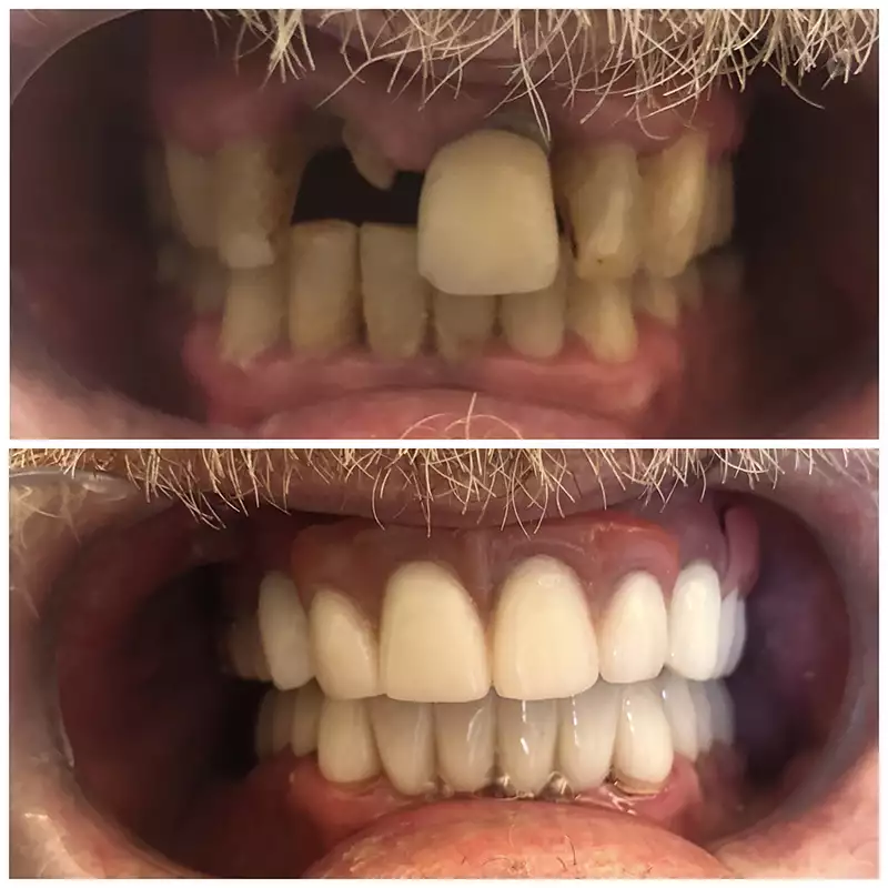 Dental Implants Before & After 4