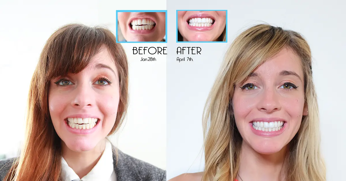 Real Invisalign Patient Before & After Side by Side Comparison