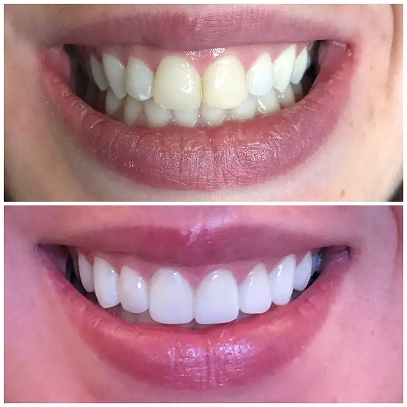 Smile Makeover Before & After 1