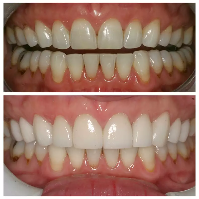 Smile Makeover Before & After 10